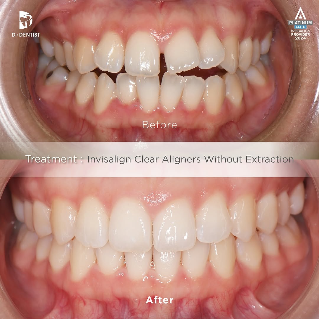 Before and After results of a patient's uneven front teeth after treatment via Invisalign (without extraction).