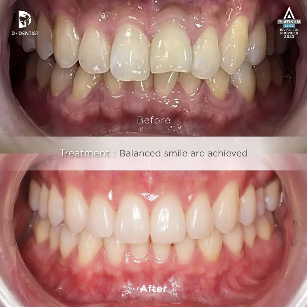 Before and After results of a patient's crooked front teeth and discoloured front teeth after treatment via root canal and internal bleaching.