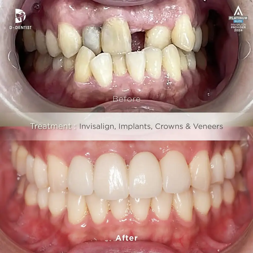 Before and After results of a patient's crowded and missing teeth after treatment via Invisalign, implants and crowns & veneers
