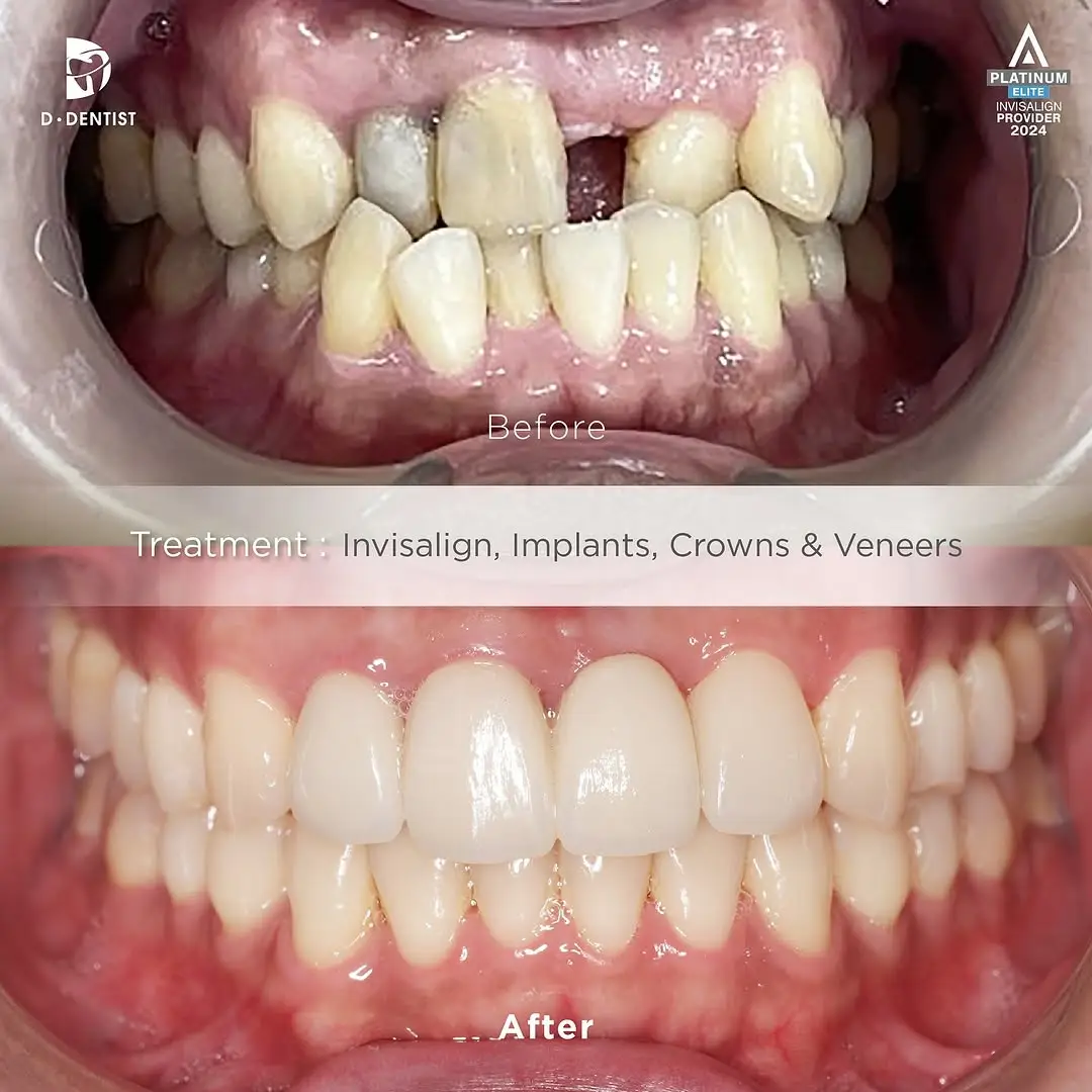 Before and After results of a patient's crowded and missing teeth after treatment via Invisalign, implants and crowns & veneers