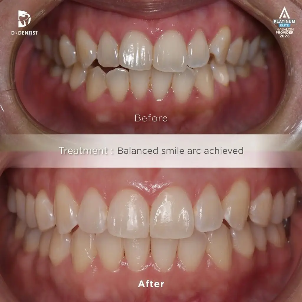 Before and After results of a patient's uneven front teeth after treatment via Invisalign clear aligner (without extraction).