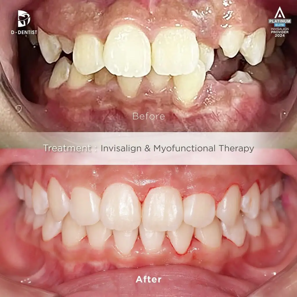 Before and After results of a patient's front teeth crowding and cross-bite after treatment via Invisalign and myofunctional therapy.