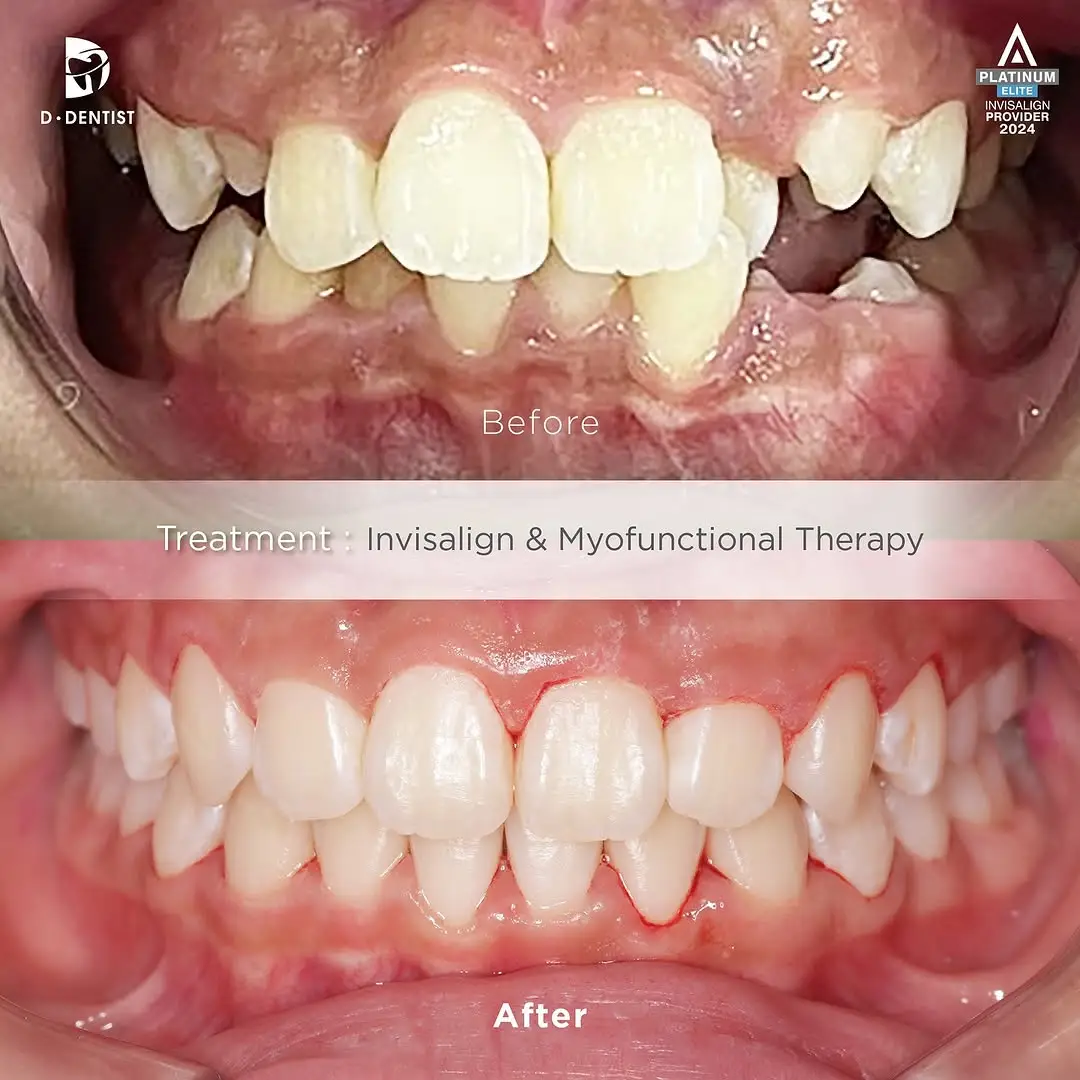 Before and After results of a patient's front teeth crowding and cross-bite after treatment via Invisalign and myofunctional therapy.