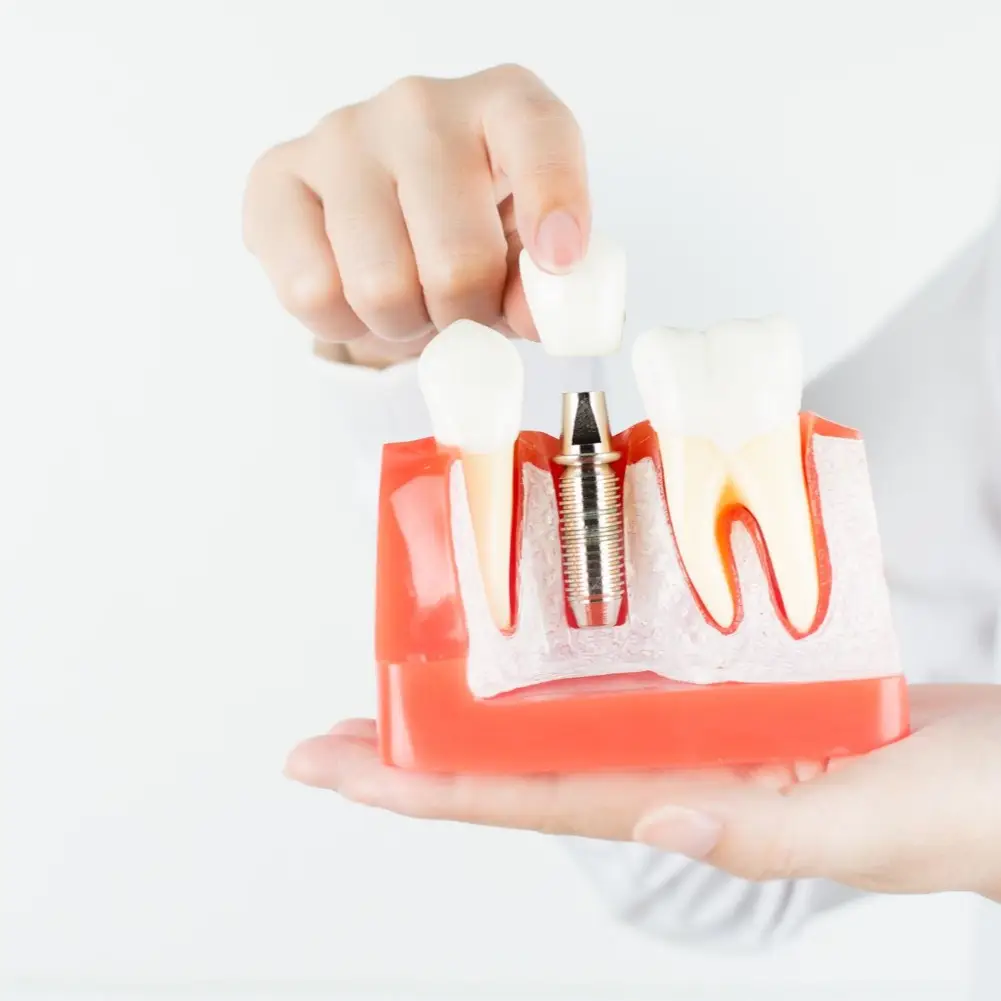 tooth replacement model
