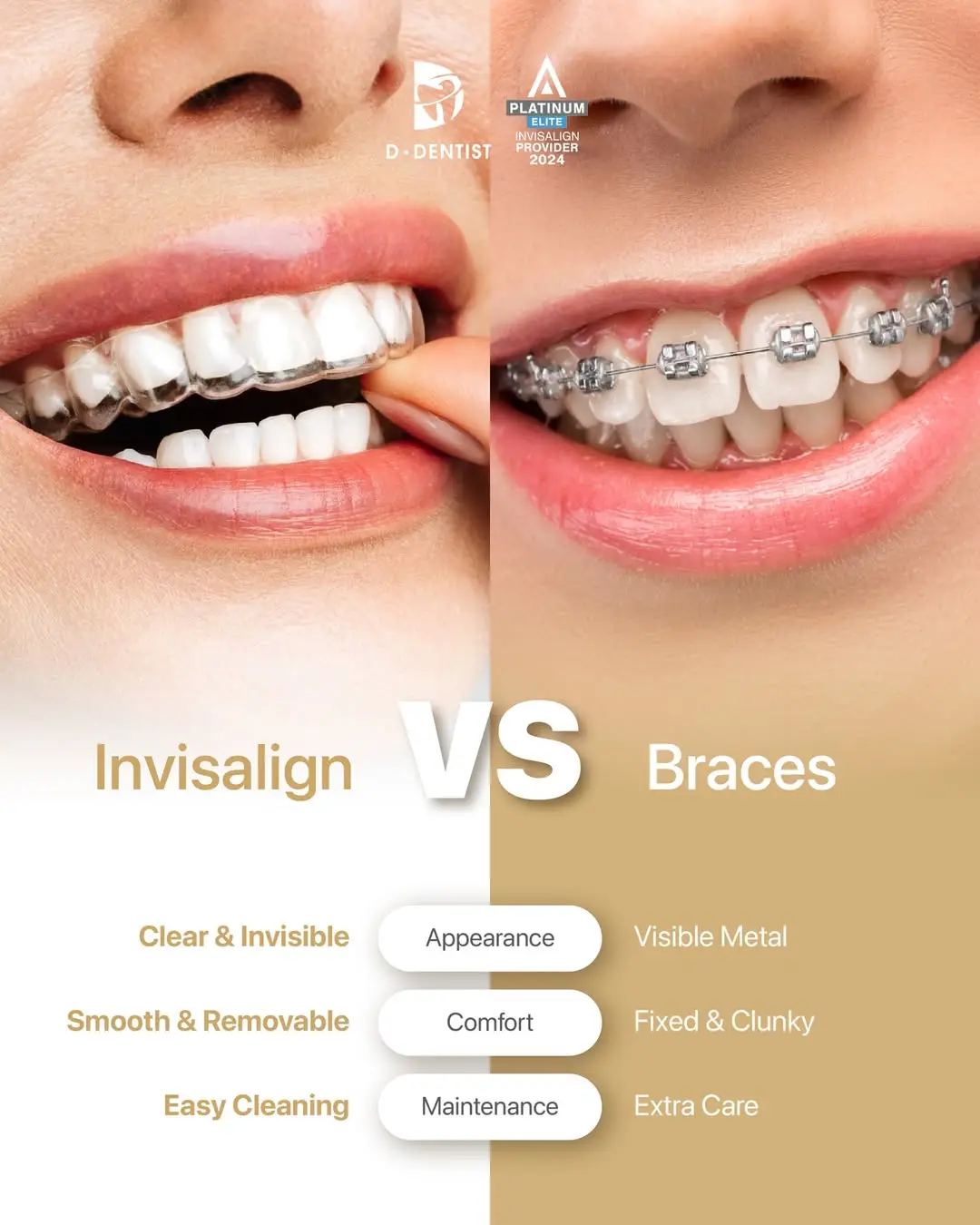 advantages of using Invisalign compared to braces